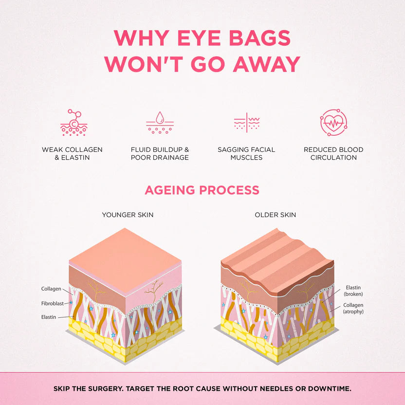 Infographic explaining common causes of under-eye puffiness and dark circles
